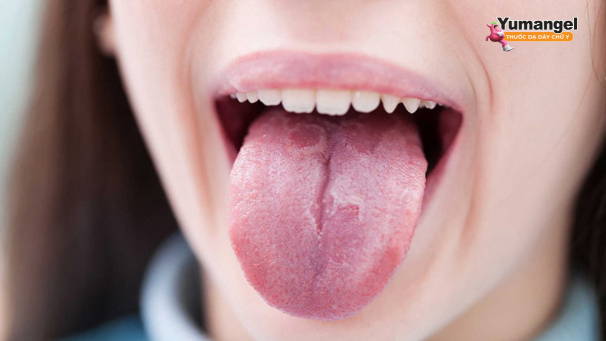 Cùng tìm hiểu trào ngược dạ dày có ảnh hưởng đến lưỡi không?