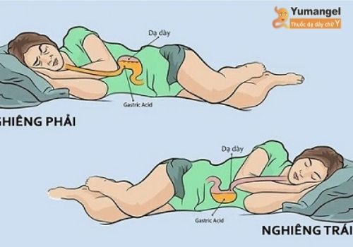 Cách nằm ngủ giúp hạn chế trào ngược dạ dày về đêm