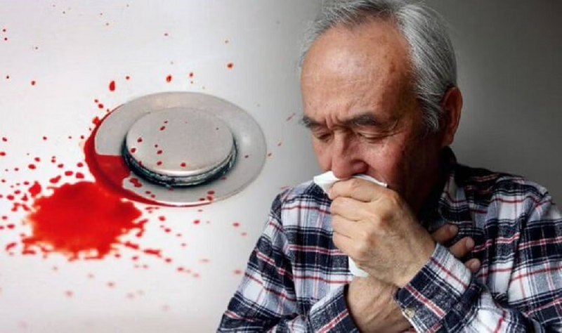 Nôn ra máu đỏ tươi là dấu hiệu xuất huyết tiêu hóa trên cấp tính.