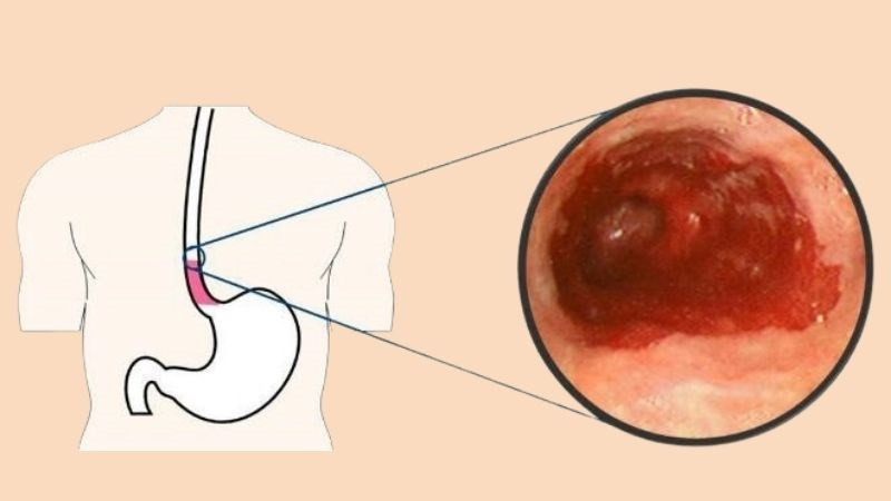 Ổ loét thực quản gây chảy máu do trào ngược dạ dày thực quản