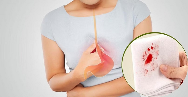 Hình ảnh minh họa tình trạng viêm thực quản ăn mòn do trào ngược dạ dày.