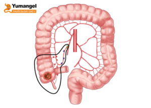U manh tràng là tình trạng xuất hiện các khối u ở đoạn đầu của ruột già