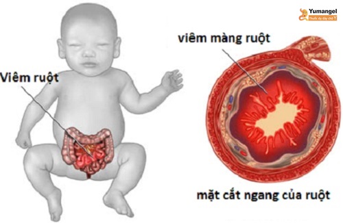 Bệnh viêm ruột hoại tử ở người lớn