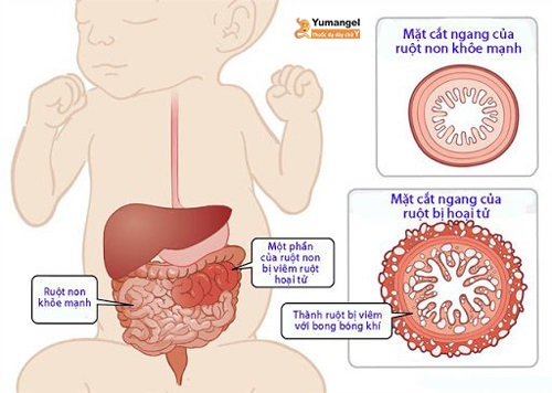 Bệnh viêm ruột hoại tử ở trẻ sơ sinh