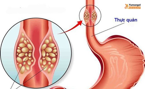 Bị u nhú thực quản có nguy hiểm không