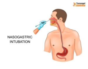 cách đặt sonde dạ dày qua mũi