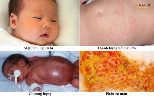 Dấu hiệu viêm ruột hoại tử sơ sinh