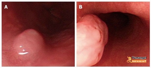 Hình ảnh u nhú thực quản