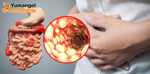 Hồi tràng là nơi dễ bị ảnh hưởng do bệnh Crohn.