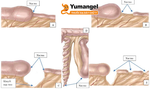 Bệnh Jejunal atresia hay teo ruột non là là bệnh lý bẩm sinh hiếm gặp.