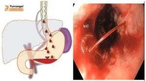 nội soi giãn tĩnh mạch thực quản