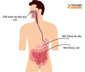 quy trình mở thông dạ dày