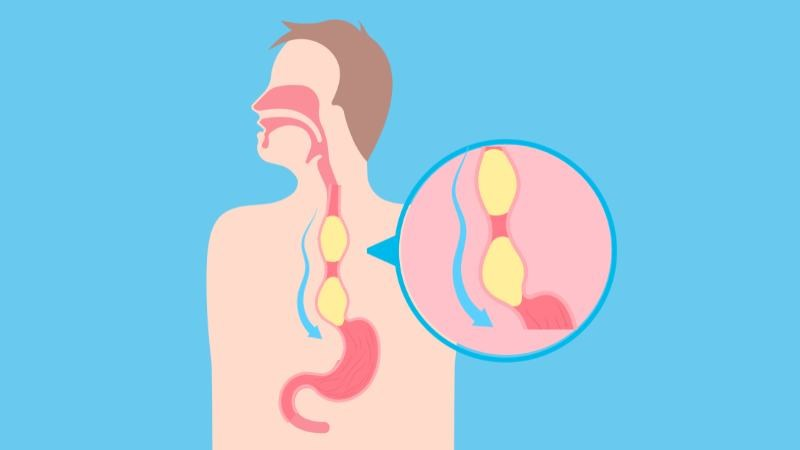 Cấu trúc van thực quản bị suy yếu trong trào ngược im lặng