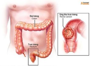 td k trực tràng là gì