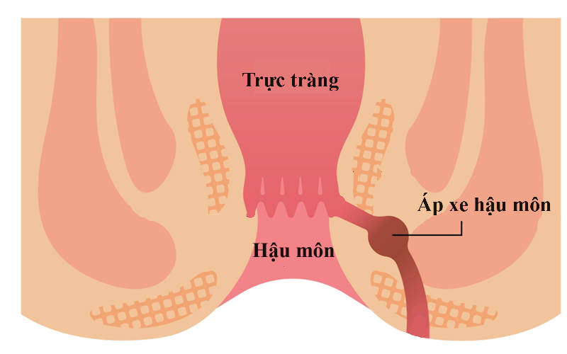 Nguyên nhân áp xe hậu môn
