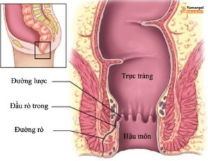 Dấu hiệu rò hậu môn trực tràng