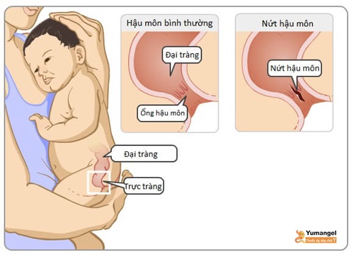 Hẹp hậu môn nguyên nhân có thể do bẩm sinh hoặc bệnh lý gây ra. 