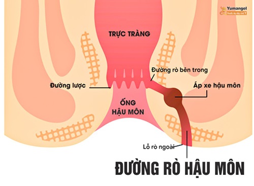 Rò hậu môn ở trẻ sơ sinh