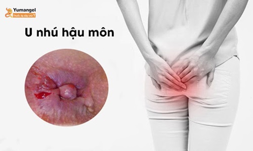 U nhú hậu môn khiến bệnh nhân khó chịu, sưng tấy và chảy máu ở hậu môn. 