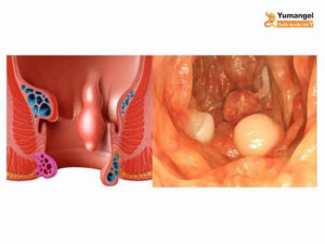 bệnh polyp ở hậu môn