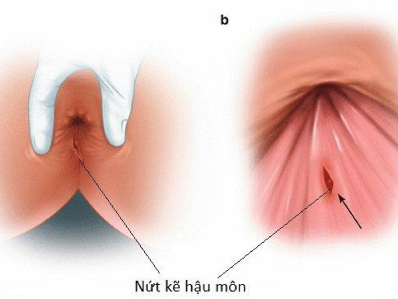 chảy máu hậu môn