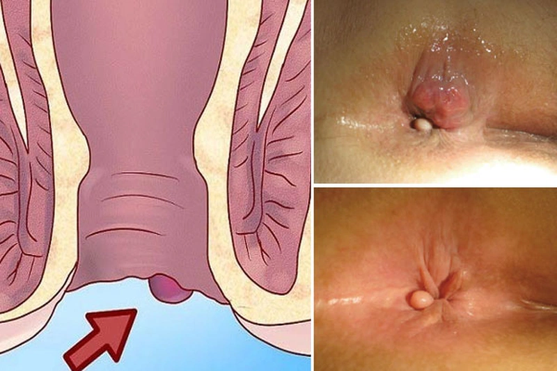 chảy máu hậu môn