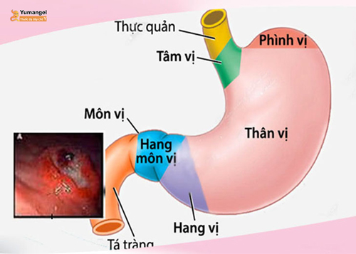 loét thân vị dạ dày