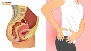 Ung thư hậu môn triệu chứng