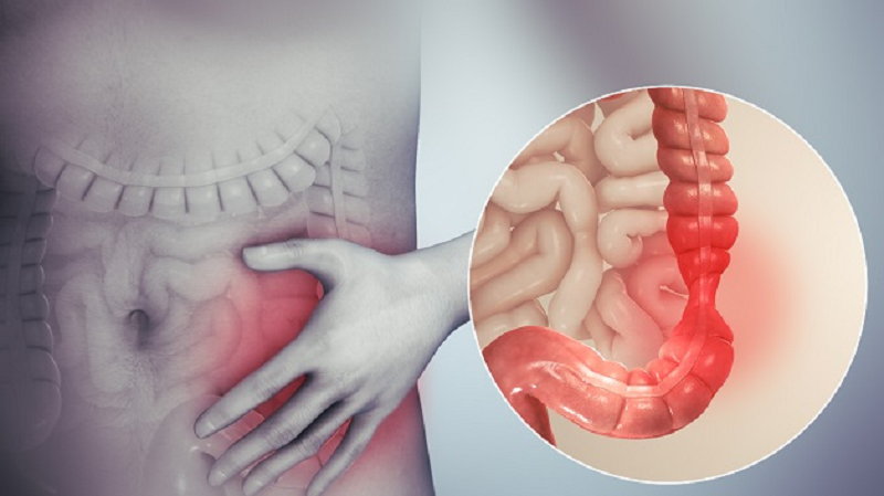 viêm hậu môn là gì