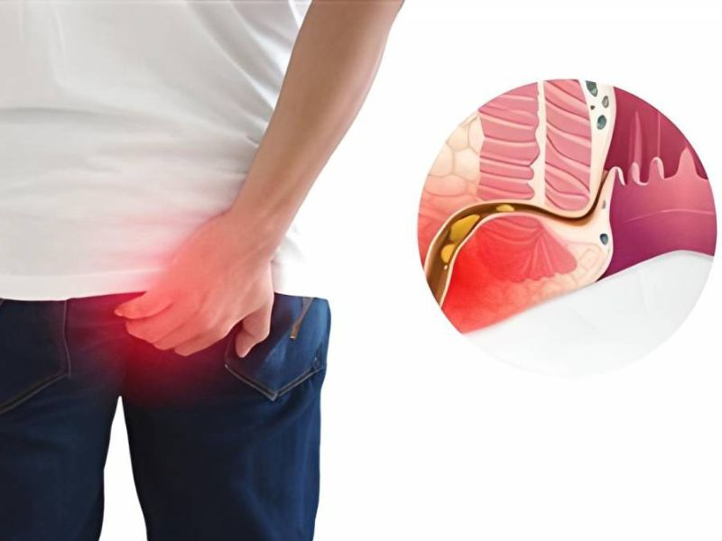 Triệu chứng của viêm hậu môn