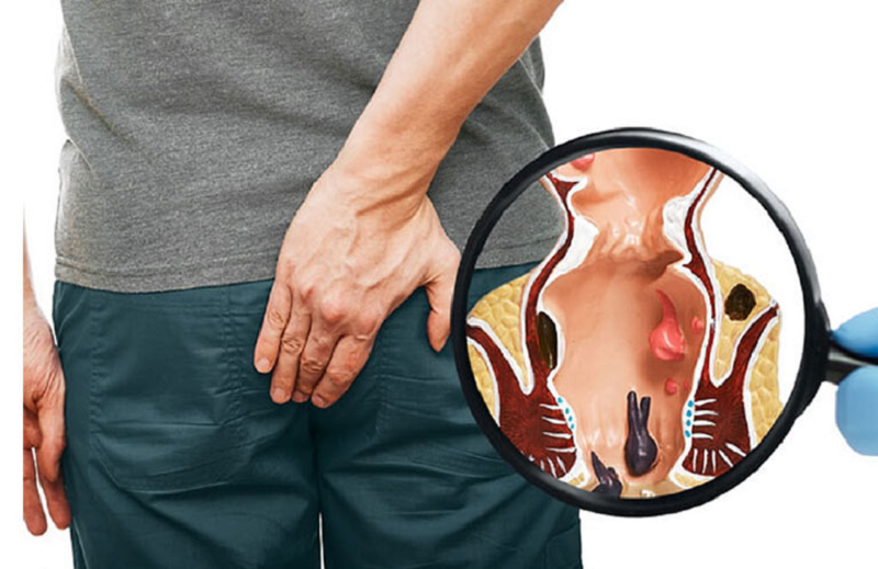 bệnh viêm hậu môn là gì