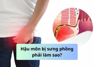 hậu môn bị sưng