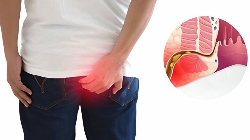 Dấu hiệu của hậu môn bị sưng
