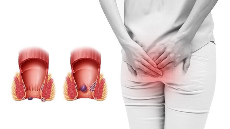 nguyên nhân khiến hậu môn có mùi hôi