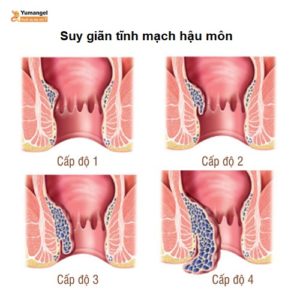 hậu môn bị giãn tĩnh mạch