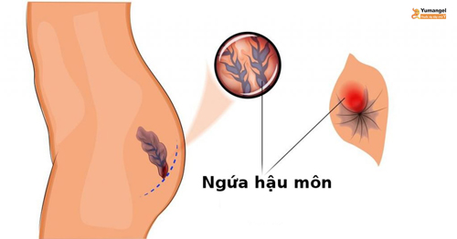 Ngứa hậu môn khi có bầu nếu không được điều trị có thể gây viêm nhiễm, chảy máu và sưng đau hậu môn.