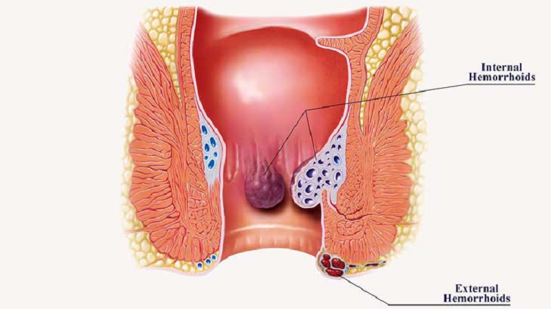 suy giãn tĩnh mạch hậu môn