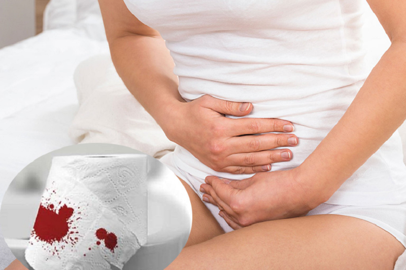 suy giãn tĩnh mạch hậu môn