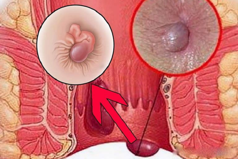 suy giãn tĩnh mạch hậu môn