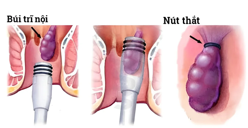 suy giãn tĩnh mạch hậu môn