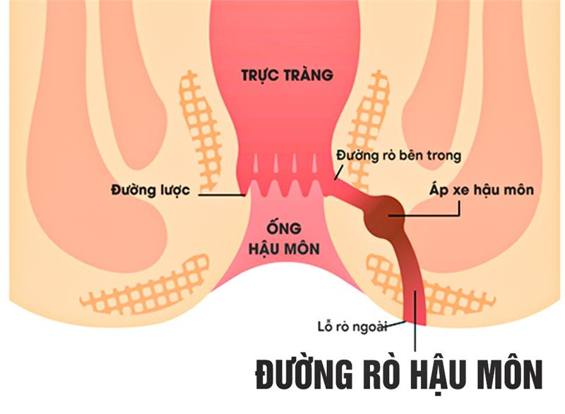thốn hậu môn
