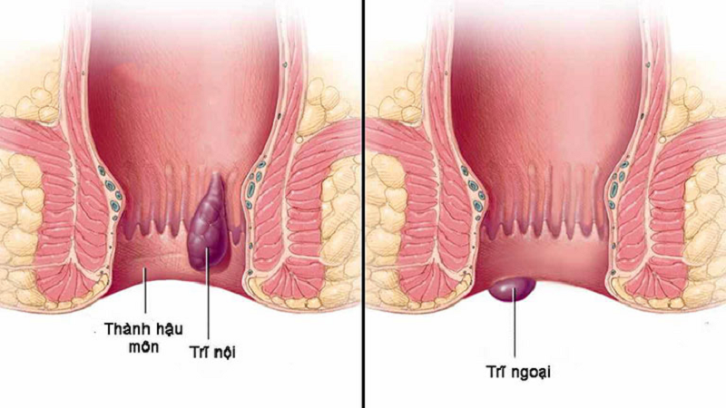 thốn hậu môn
