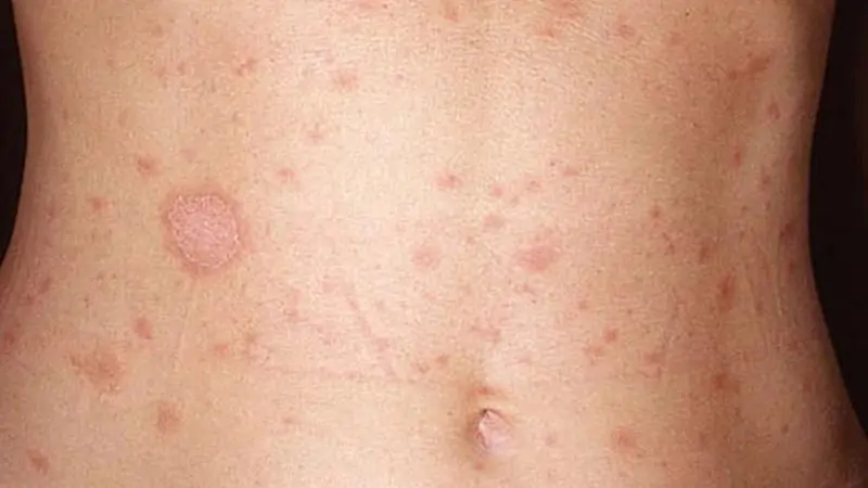 Biểu hiện hậu môn bị giang mai