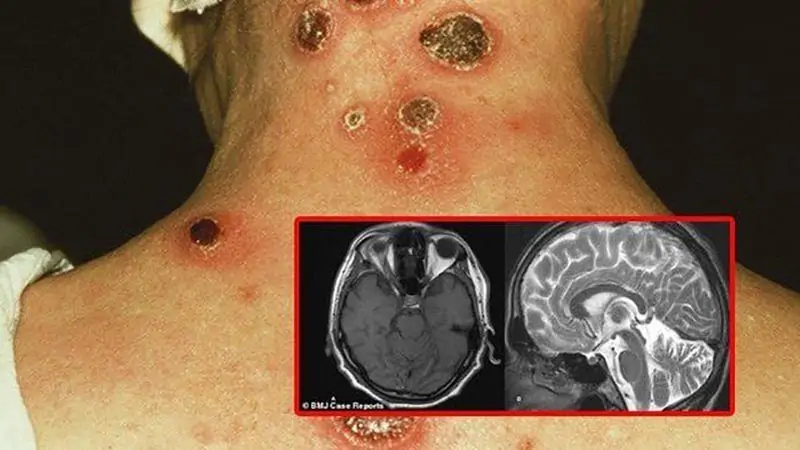 Biến chứng nguy hiểm