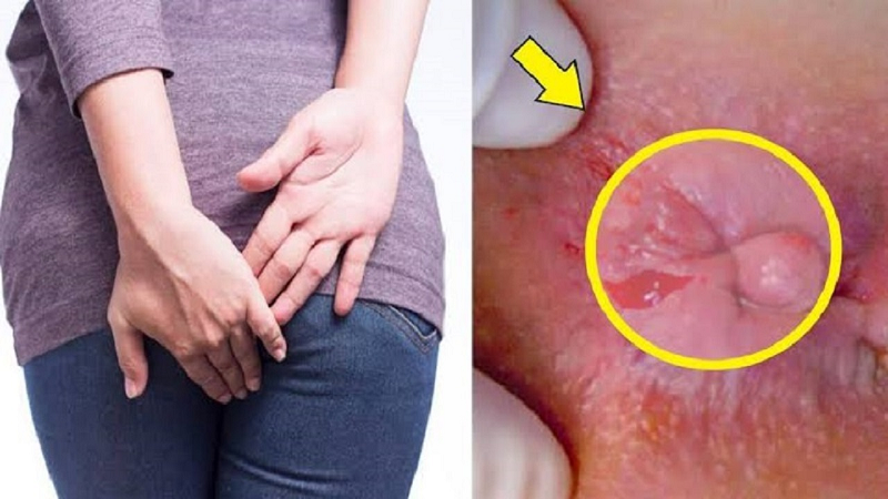 hậu môn chảy dịch có mùi hôi