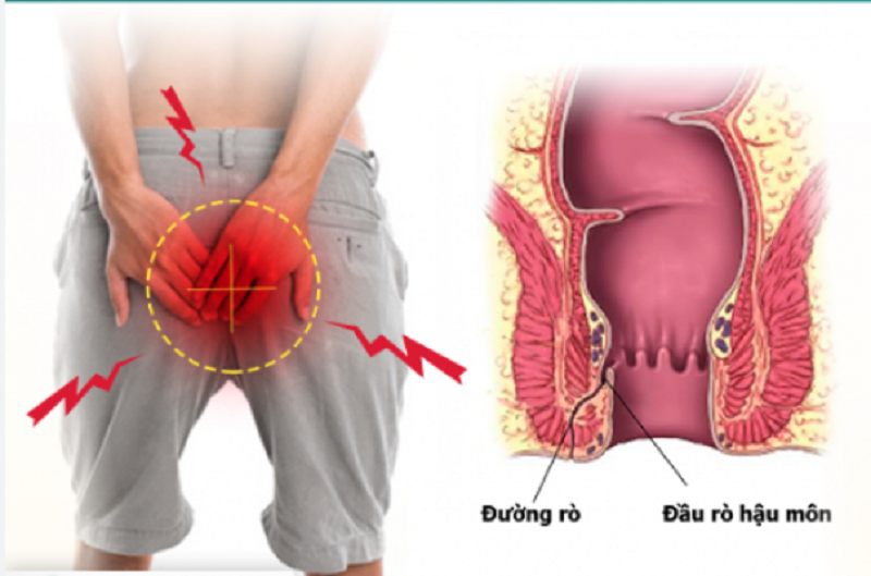 hậu môn chảy dịch có mùi hôi