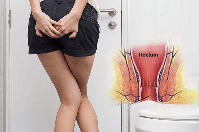 hậu môn có dịch màu trắng