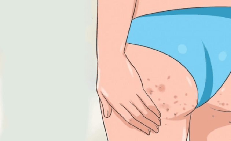Phòng ngừa mụn ở hậu môn