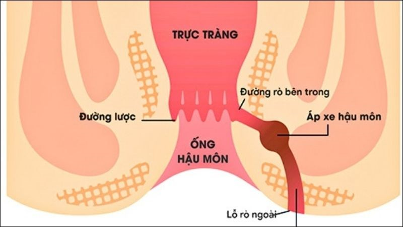 Bệnh lý hậu môn - trực tràng