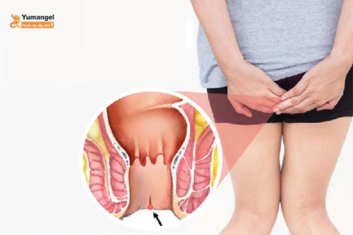 Rách hậu môn là gì? Có nguy hiểm không? Nguyên nhân và cách điều trị